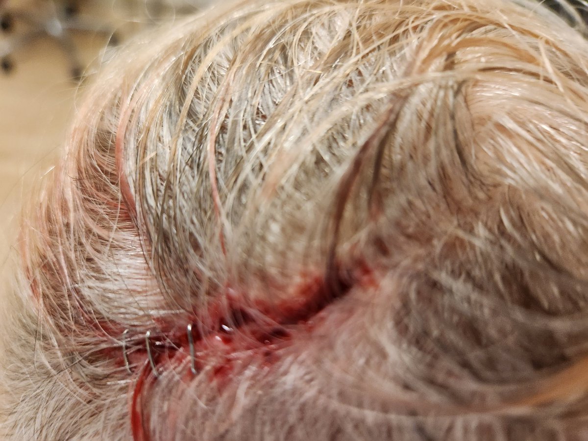 Newellbride's tweet photo. @RoomsToGo An unsecured vase sitting on a dresser fell on my 74-year-old mother's head in your Augusta, GA store tonight. She has a huge gash that required staples on the top of her head. Is this kind of negligence standard in your stores? How will you make this right? https://t.co/FjfvTYIEZe