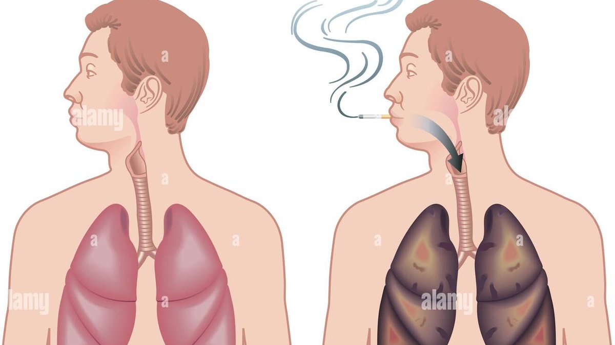 Neurosciencean3's tweet photo. #Cigarettes Ignite the #Risk of #Mental #Illness 
Read more: https://t.co/INCgetGO3o 
submit your paper on: https://t.co/GSMlgBokKS 
#npoa 
#manuscript 
#reseach 
#Mental #health https://t.co/PLWSBLHbUL
