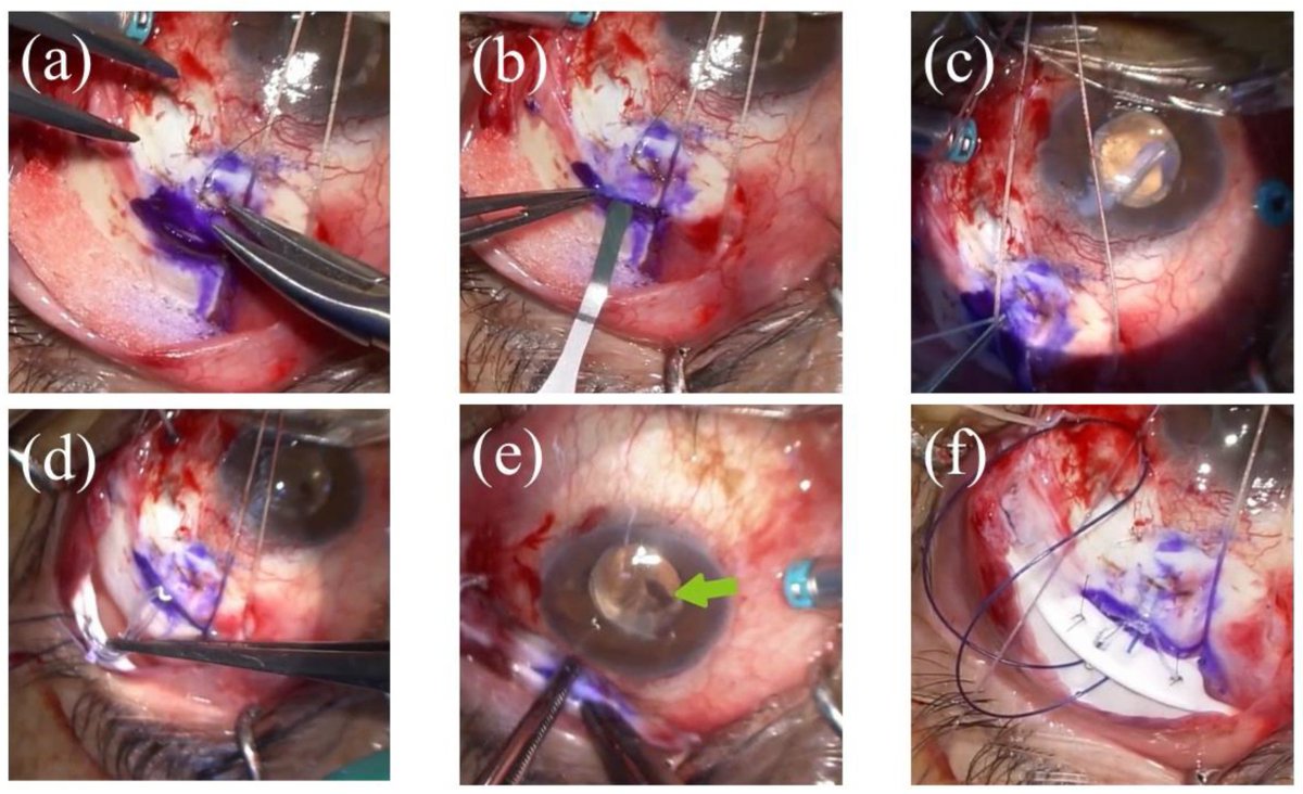 UniversalSurge1's tweet photo. Long-term outcomes of Baerveldt #glaucoma #implant #surgery in #Japanese patients 
Read more: https://t.co/sTRjzVvsAc 
submit your paper on: https://t.co/7f9IQq9XFt 
#ipjus 
#manuscript 
#reseach 
#Glaucoma #Surgery https://t.co/lEuIVQTeSw