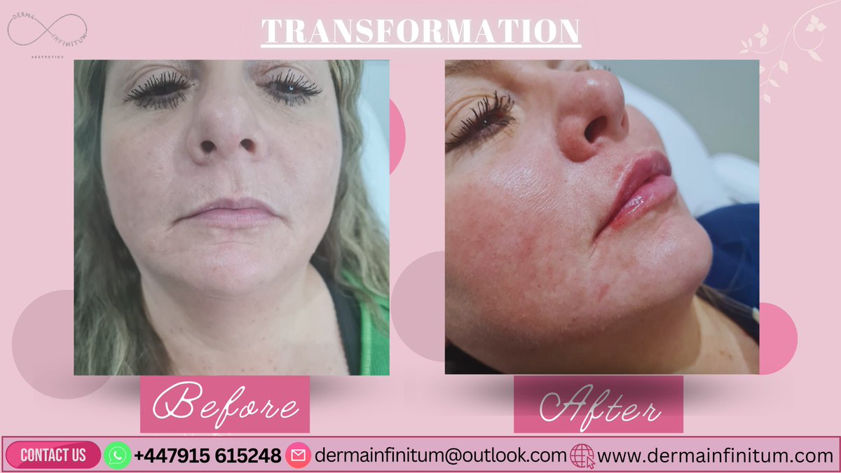 From subtle to sensational 💋:  
Witness the transformative power of lip fillers.  
See the before and after magic! 📷✨ 

#LipFillerJourney #AestheticGoals #PlumpPerfection #BeforeAndAfterGlow #LipRevolution