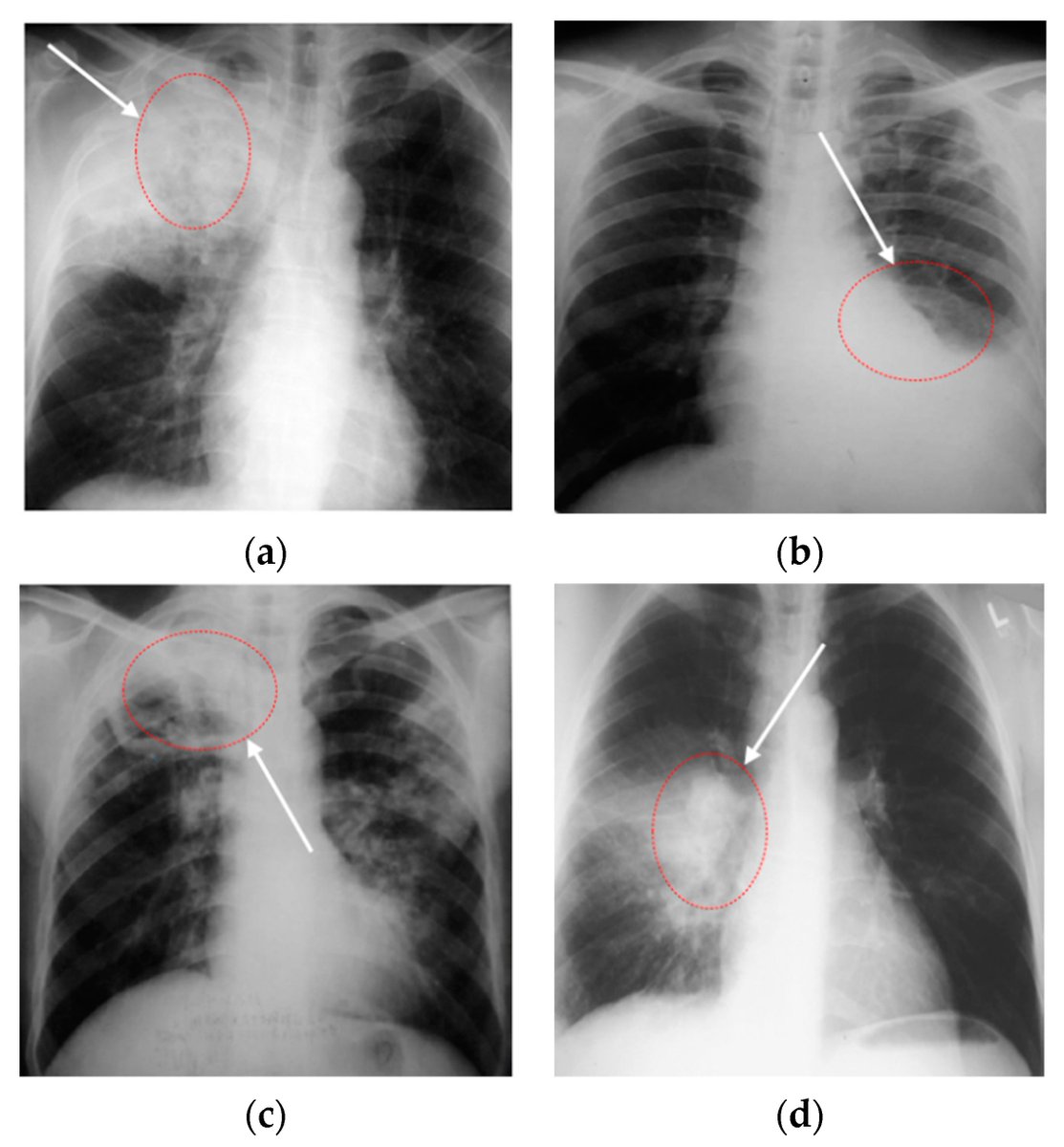 Sensors_MDPI's tweet photo. #highlycitedpaper
E-TBNet: Light Deep Neural Network for Automatic Detection of Tuberculosis with X-ray DR Imaging
https://t.co/cUsq3k3zBj
#tuberculosisdetection #chest #Xrayimages #neuralnetwork #embeddeddevice https://t.co/DPQnZx9T1T