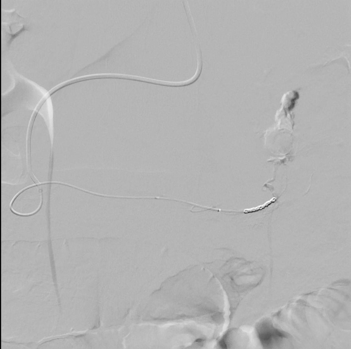 Coil and Gelfoam embolization for active extravasation from a branch of the right gastroepiploic artery using left radial access 
#IRad #TwittIR #radialaccess