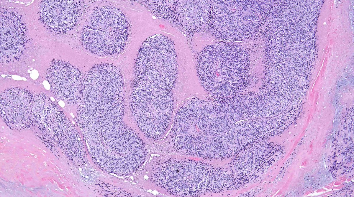 DavidSusterMD (@mdsuster) on Twitter photo Soft tissue mass- subcutaneous lesion with deep penetration, middle aged patient (3rd-5th decade):
Anyone got any ideas based off of the H&E?? No IHC, no molecular, no wrong answers
#PathTwitter #bstpath #surgpath <a href="/01sth02/">syed t. hoda</a> <a href="/JMcMahonG/">John Gross, MD</a> <a href="/Michael_Kallen_/">Michael Kallen</a> <a href="/Vik_deshpandeMD/">Vikram Deshpande</a> Soft tissue mass- subcutaneous lesion with deep penetration, middle aged patient (3rd-5th decade):
Anyone got any ideas based off of the H&E?? No IHC, no molecular, no wrong answers
#PathTwitter #bstpath #surgpath <a href="/01sth02/">syed t. hoda</a> <a href="/JMcMahonG/">John Gross, MD</a> <a href="/Michael_Kallen_/">Michael Kallen</a> <a href="/Vik_deshpandeMD/">Vikram Deshpande</a>