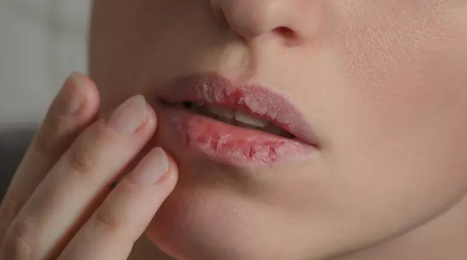 Salah satu hal yang bikin insecure:
Gebetan notice kalo bibirku pecah-pecah..😩

Sini deh, mimin spill sesuatu:
👄 TIPS BIAR BIBIR PECAH-PECAH HEMPAS 👄