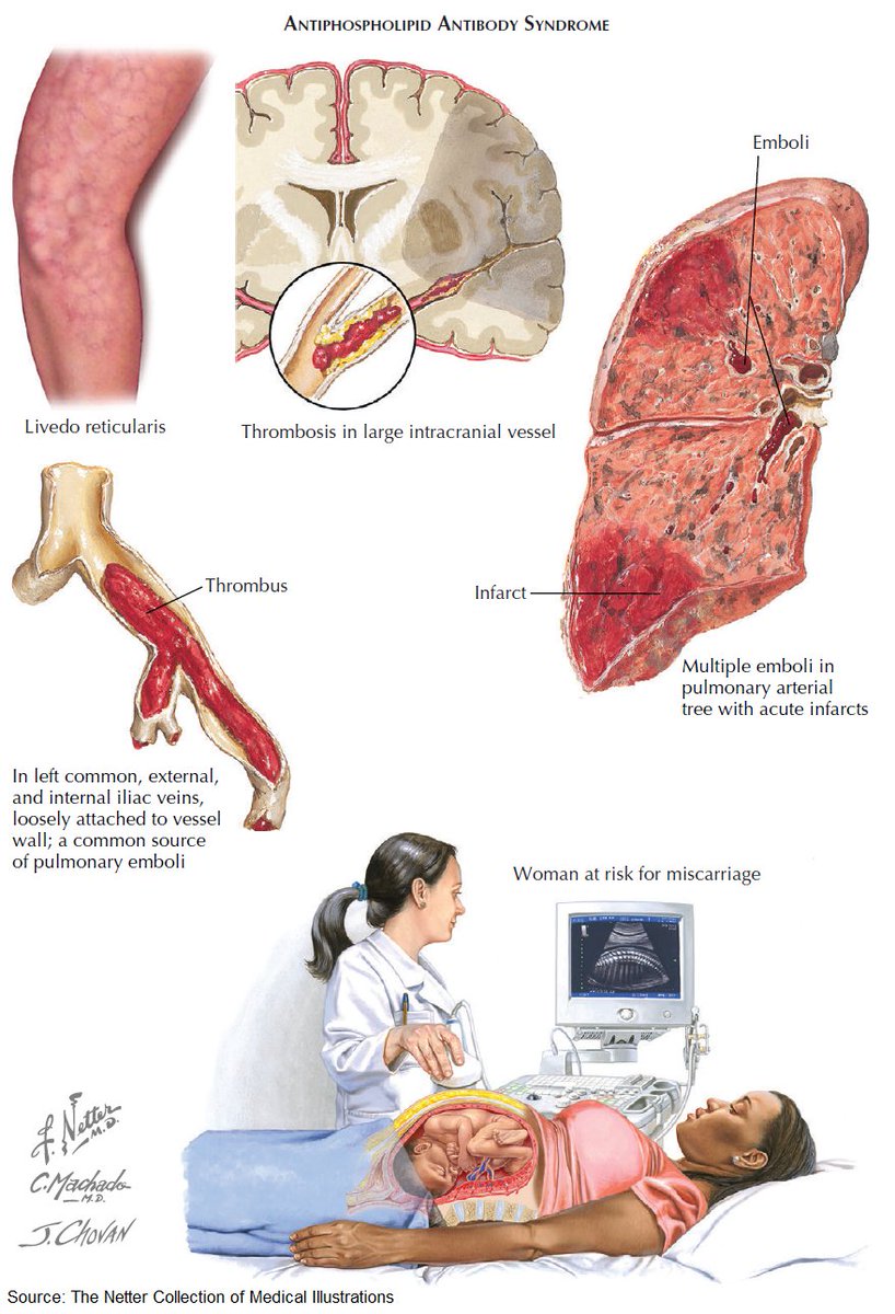 Antiphospholipid Antibody syndrome. 🫁