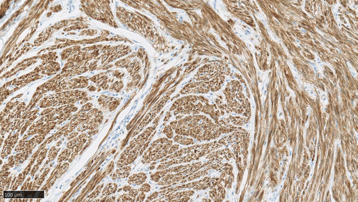 CerbaResearch_'s tweet photo. In this week's featured #ImageOfTheWeek, we showcase the p16 expression in Uterine Leiomyosarcoma.

This specific protocol has been rigorously validated at the secondary endpoint level. 

#TransformingResearch #AdvancingHealth https://t.co/NaKfupXJ0A