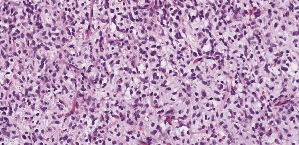 kiko4docs's tweet image. What is this myxoid tumor? 
Answer: kikoxp.com/posts/11195 
More posts from Dr. Hassell @HassellLewis kikoxp.com/lewis_a_hassel…
#pathology #pathTwitter #medTwitter #BSTpath