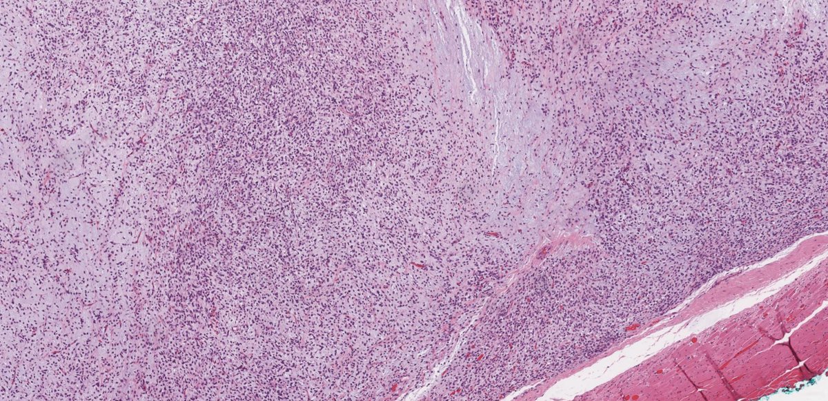 What is this myxoid tumor? Answer: kikoxp.com/posts/11195 More posts from Dr. Hassell @HassellLewis kikoxp.com/lewis_a_hassel… #pathology #pathTwitter #medTwitter #BSTpath