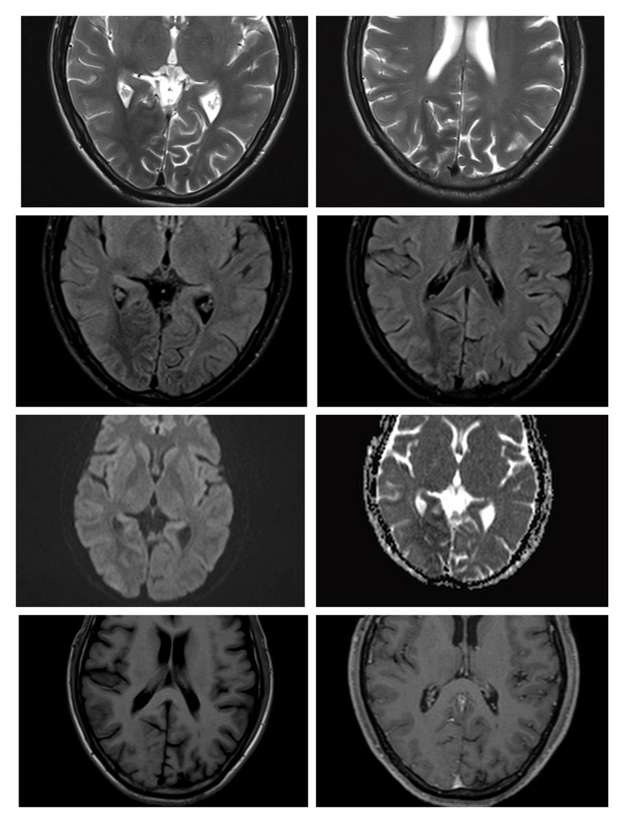 35 year old with gradually progressive left homonymous hemianopia.

Usually white matter pathologies are hyperintense on T2 and FLAIR.

But when is white matter hypointense on T2 and FLAIR, isointense on T1, without diffusion restriction or post contrast enhancement?

🧵