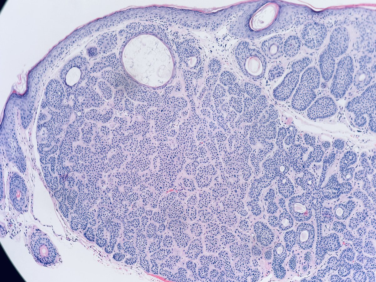 Henry YANG (@henryy_md) on Twitter photo #dermpath
Happy first day of September!
71 yo man nose.
You call this BCC or TE?😊
<a href="/JacobSmalberger/">Jacob Smalberger, M.D.</a> <a href="/mccalmo/">Tim McCalmont</a> <a href="/et565/">Etan Marks, DO</a> <a href="/MarcelaSaebL/">Marcelasaeblima.</a> <a href="/DrGeeONE/">Olaleke Folaranmi</a> <a href="/kis_lorand/">Lorand Kis</a> @ArjunRamaiya1 <a href="/DiegoMoralesN/">Diego Morales, MD</a> <a href="/gonzadetoro/">Gonzalo De Toro</a> <a href="/tonitatirado/">Mariantonieta Tirado</a> <a href="/pepeheffernan/">Pepe Jiménez Heffernan</a> <a href="/david_terrano/">David Terrano</a> #dermpath
Happy first day of September!
71 yo man nose.
You call this BCC or TE?😊
<a href="/JacobSmalberger/">Jacob Smalberger, M.D.</a> <a href="/mccalmo/">Tim McCalmont</a> <a href="/et565/">Etan Marks, DO</a> <a href="/MarcelaSaebL/">Marcelasaeblima.</a> <a href="/DrGeeONE/">Olaleke Folaranmi</a> <a href="/kis_lorand/">Lorand Kis</a> @ArjunRamaiya1 <a href="/DiegoMoralesN/">Diego Morales, MD</a> <a href="/gonzadetoro/">Gonzalo De Toro</a> <a href="/tonitatirado/">Mariantonieta Tirado</a> <a href="/pepeheffernan/">Pepe Jiménez Heffernan</a> <a href="/david_terrano/">David Terrano</a>