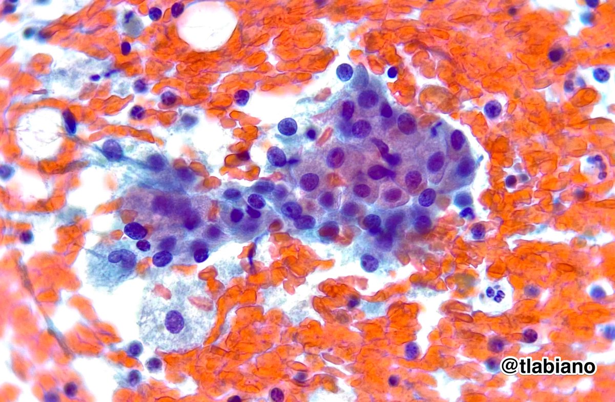 tlabiano's tweet photo. Classic diagnostic triad of Warthin Tumor on #cytology for #FNAfriday

Oncocytes, lymphocytes and cyst content
🥇✌🏻3️⃣🙌🏼💃🏻

Have a nice weekend!

#MilanSystem #cytopath #cytopathclassics #papstain #pathresidents #cytoABCs https://t.co/68eO6MJ0f6