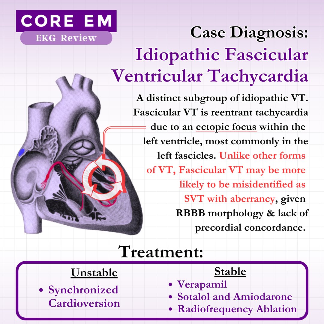 Core_EM's tweet photo. Let’s add one additional diagnosis to consider when analyzing a wide complex tachycardia, especially in our young healthy patients..

🧵 4/5 #MedTwitter https://t.co/YvxAxQiXW1