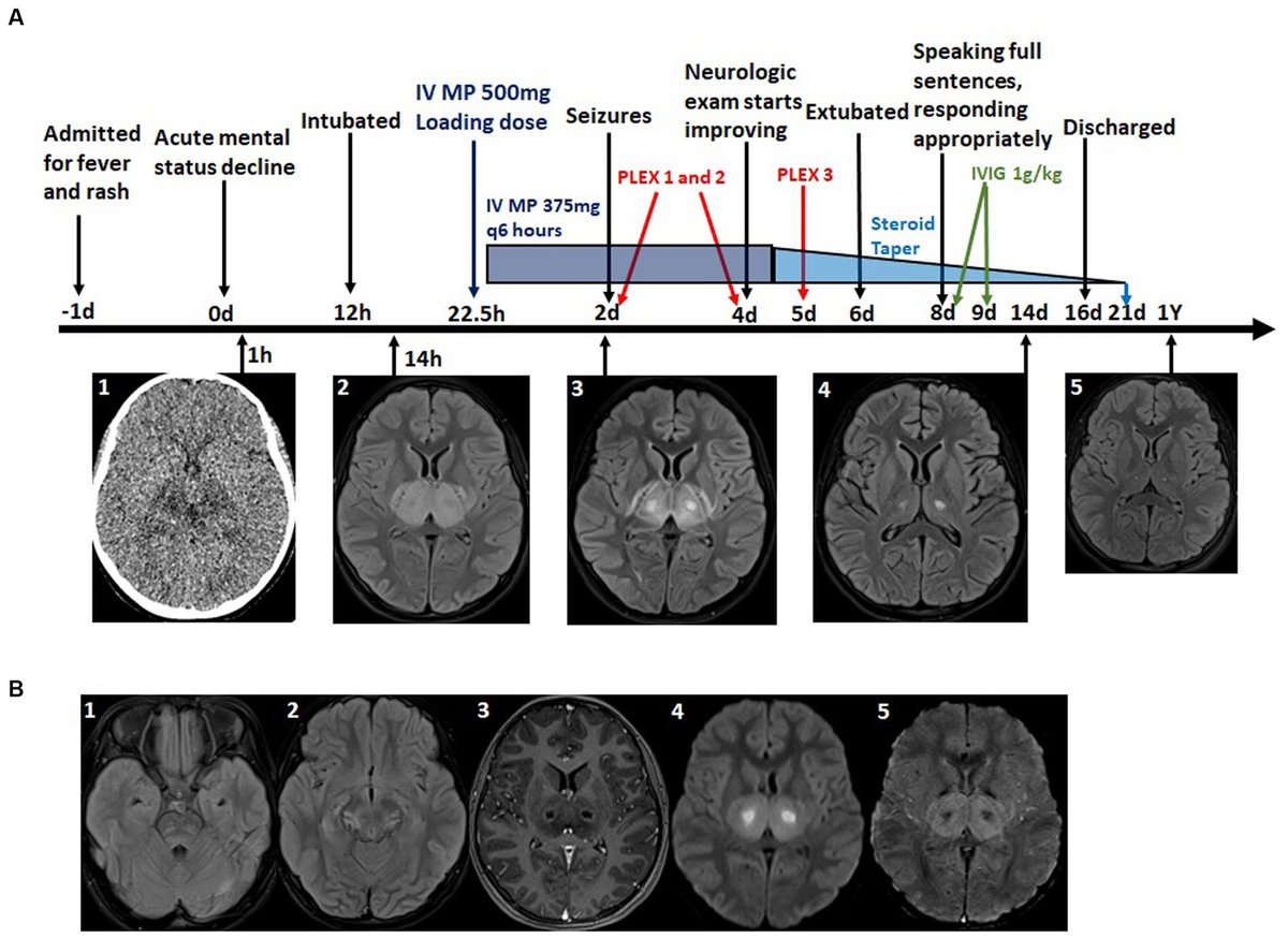 Delighted to share our paper in <a href="/FrontNeurol/">Frontiers - Neurology</a> on acute necrotizing encephalopathy 🧠 #PedsICU. Kudos to some fab residents and APPs at @UMMS led by former chief resident Stefanie Fischell. A great addition to the limited literature on ANE. Please share! tinyurl.com/4mv3ndxz
