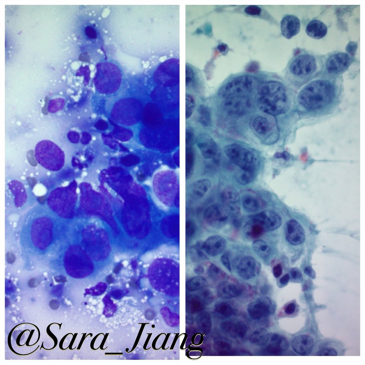 Sara_Jiang's tweet photo. Today’s #FNAFriday #DQvsPAP!
Must-know #Thyroid diagnosis: Anaplastic Carcinoma
👀 Highly atypical cells with lots of apoptosis without evidence of specific differentiation on DQ (L)
🔎 Chunky chromatin best appreciated on Pap (R) https://t.co/uSzwzen5pR