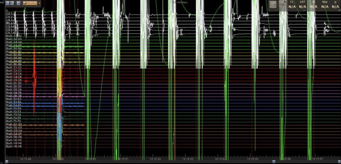 GustavoRRodrigues (@life_activist_) on Twitter photo End of a loooong week with a mitral flutter stopping with single shot focal eletroporation (Visigo+Octaray). Previous PVI + Box lesion. Skin2skin 60 min. <a href="/cgmarinescu/">Cătălin Marinescu</a> @dianaHuyda @Padragao <a href="/Moscoso_Costa/">Francisco M. Costa</a> @AnaLucia 🔥🔥💪💪 End of a loooong week with a mitral flutter stopping with single shot focal eletroporation (Visigo+Octaray). Previous PVI + Box lesion. Skin2skin 60 min. <a href="/cgmarinescu/">Cătălin Marinescu</a> @dianaHuyda @Padragao <a href="/Moscoso_Costa/">Francisco M. Costa</a> @AnaLucia 🔥🔥💪💪