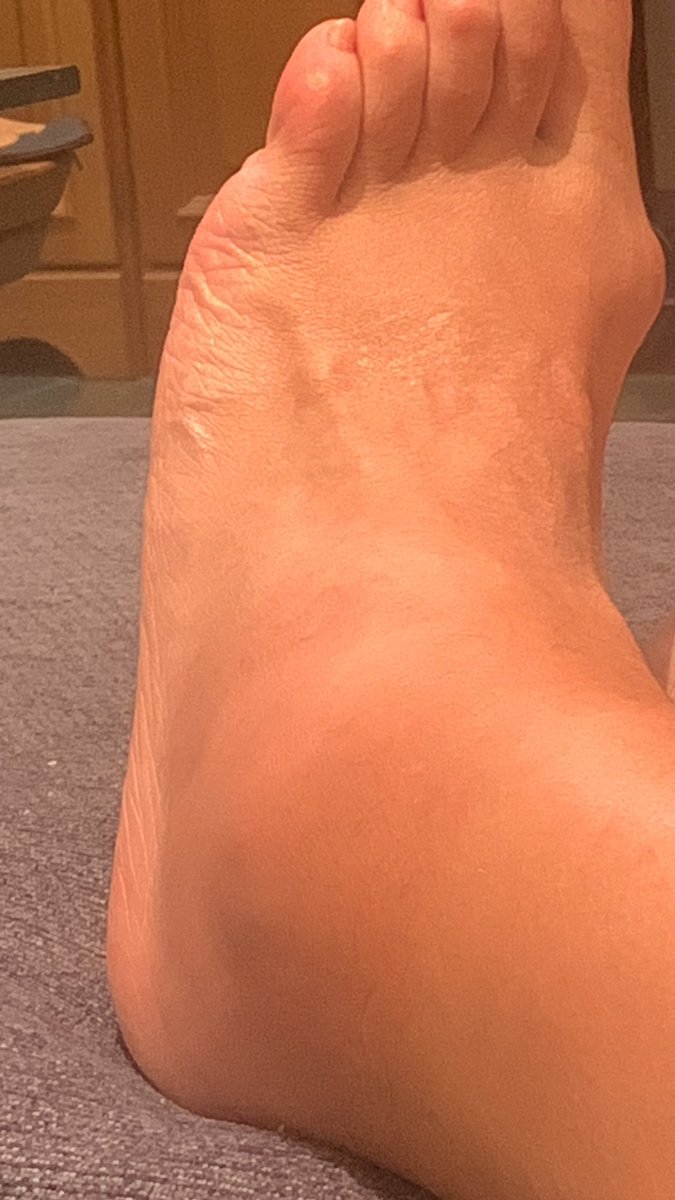 Yo, mis tobillos, y el enésimo esguince….😞