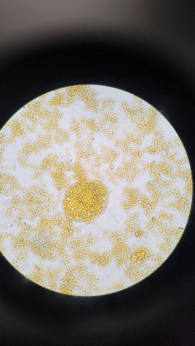 Marc Couturier PhD, D(ABMM) 🕷🦠🔬 (@parasite_power) on Twitter photo Busy week so I am dumping some fun cases all at once.
Found in a wet mount body fluid exam. Source: liver cyst, aspirate contents
This is a lob-ball, but always fun.
Dx?
How did the patient acquire this?
#parasitology
<a href="/ARUPLabs/">ARUP Laboratories</a>
<a href="/ParasiteGal/">Bobbi Pritt, MD</a> Busy week so I am dumping some fun cases all at once.
Found in a wet mount body fluid exam. Source: liver cyst, aspirate contents
This is a lob-ball, but always fun.
Dx?
How did the patient acquire this?
#parasitology
<a href="/ARUPLabs/">ARUP Laboratories</a>
<a href="/ParasiteGal/">Bobbi Pritt, MD</a>