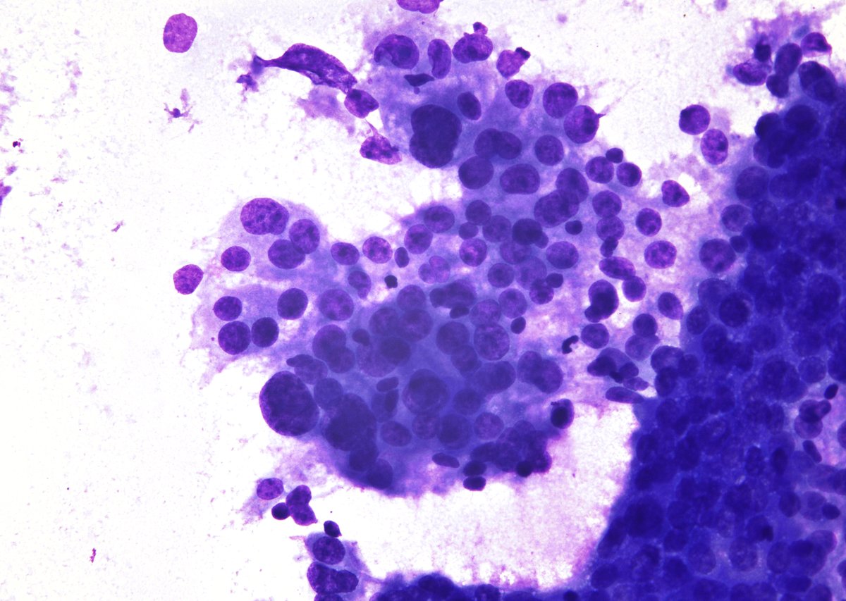 sza_jhcyto's tweet photo. Thyroid FNA in a patient with a previous history of "Breast Ductal Carcinoma", consistent with metastasis. Key would be a total lack of colloid on the smears, previous history and IHC confirmation (if a CB is available). https://t.co/cCMH9hRzAR