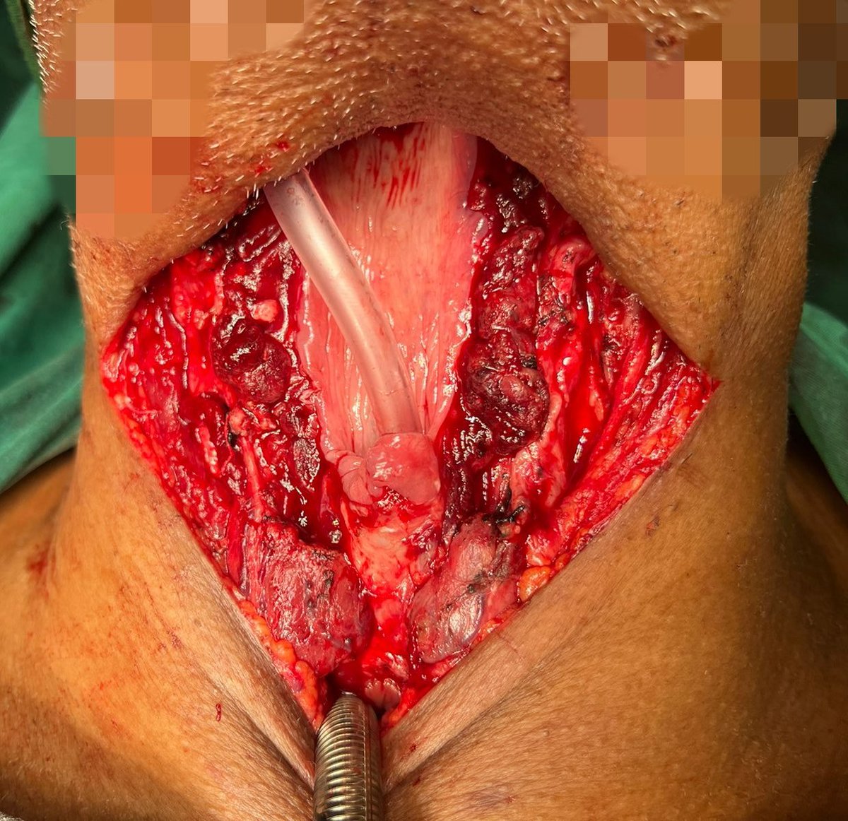 Ent_Faamch's tweet photo. Laryngectomy with partial Pharyngectomy in a case of Supraglottic SCC.
Dissected specimen shows RT AEF PFS growth encroaching the EG. 
#OTseries #ent 
@FAAMCHbarpeta 
@CMOfficeAssam 
@keshab_mahanta https://t.co/goP81Q3VkR