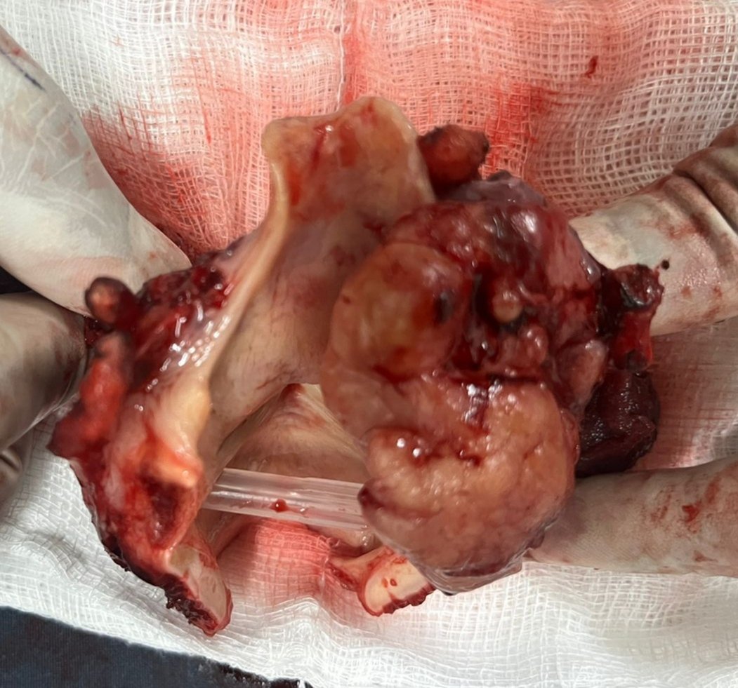 Ent_Faamch's tweet photo. Laryngectomy with partial Pharyngectomy in a case of Supraglottic SCC.
Dissected specimen shows RT AEF PFS growth encroaching the EG. 
#OTseries #ent 
@FAAMCHbarpeta 
@CMOfficeAssam 
@keshab_mahanta https://t.co/goP81Q3VkR