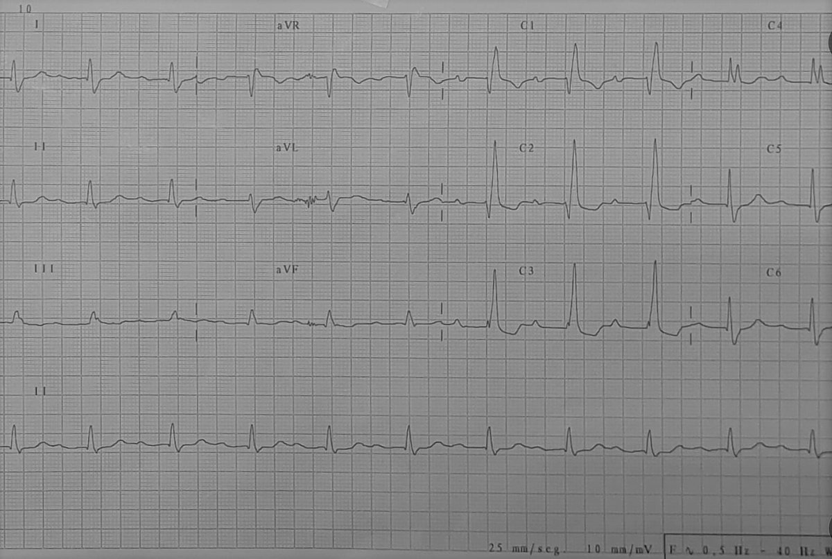 CardioAPFerrol's tweet photo. Con el fin de Agosto vuelve #CardioTopo ❤️🕵️‍♂️

Empezamos el mes con un ECG sencillito. Animaos a describirlo! https://t.co/98GG1uOe7b