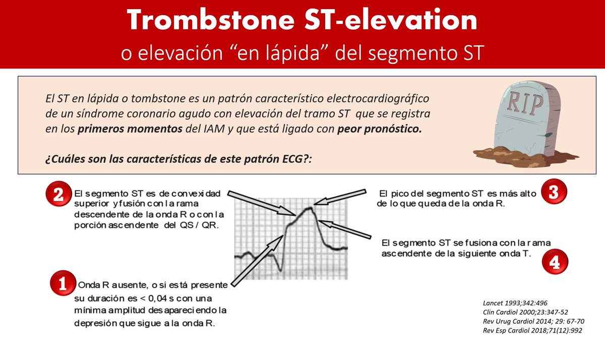 CardioAPFerrol's tweet photo. #CardioTruco #Concurso 

¡Queremos ver ECG de vuestros archivos con el patrón "en lápida" del segmento ST! 

Puede que regalemos alguna de nuestras tazas de #CardioTopo ☕️❤️🕵️‍♂️al más rápido o al más chulo... 😉 https://t.co/2VtZLABAoT