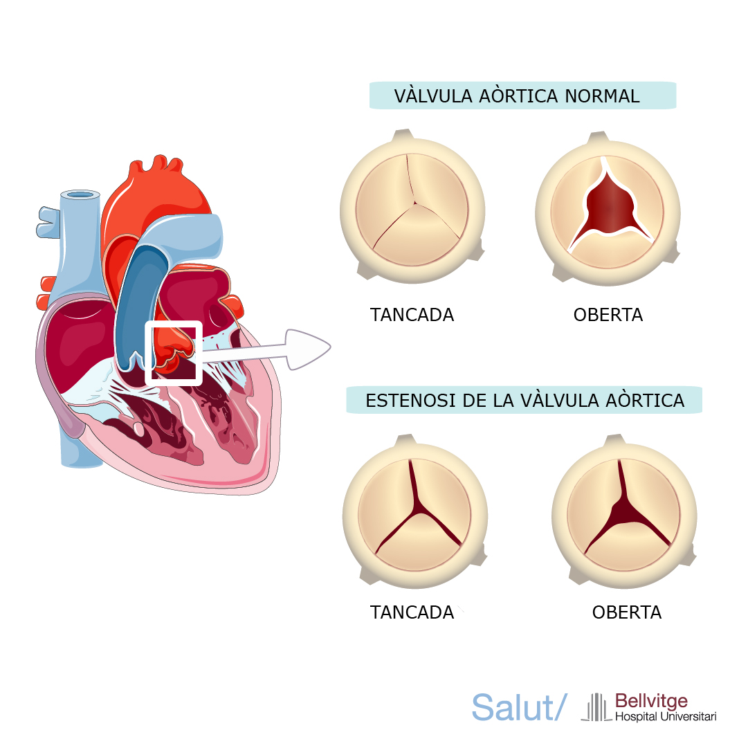 #ElMeuQuirofan | Com és la cirurgia per resoldre les patologies de la vàlvula aòrtica del nostre cor? ℹ️ Descobreix com realitzem la cirurgia de vàlvula aòrtica a: mtr.cool/vcjcxbpiwq #cardiologia #cca #car