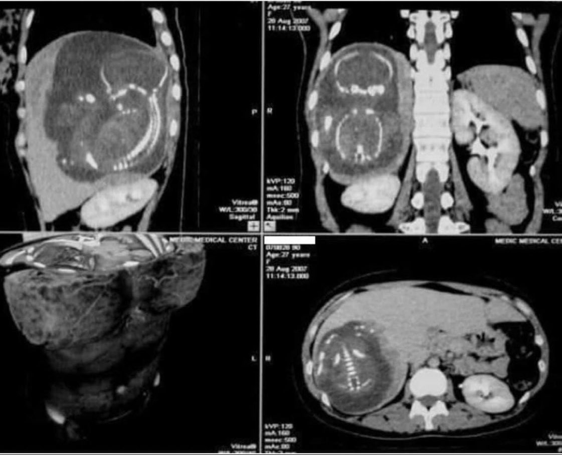 An unusual mass in the liver. What’s going on here?