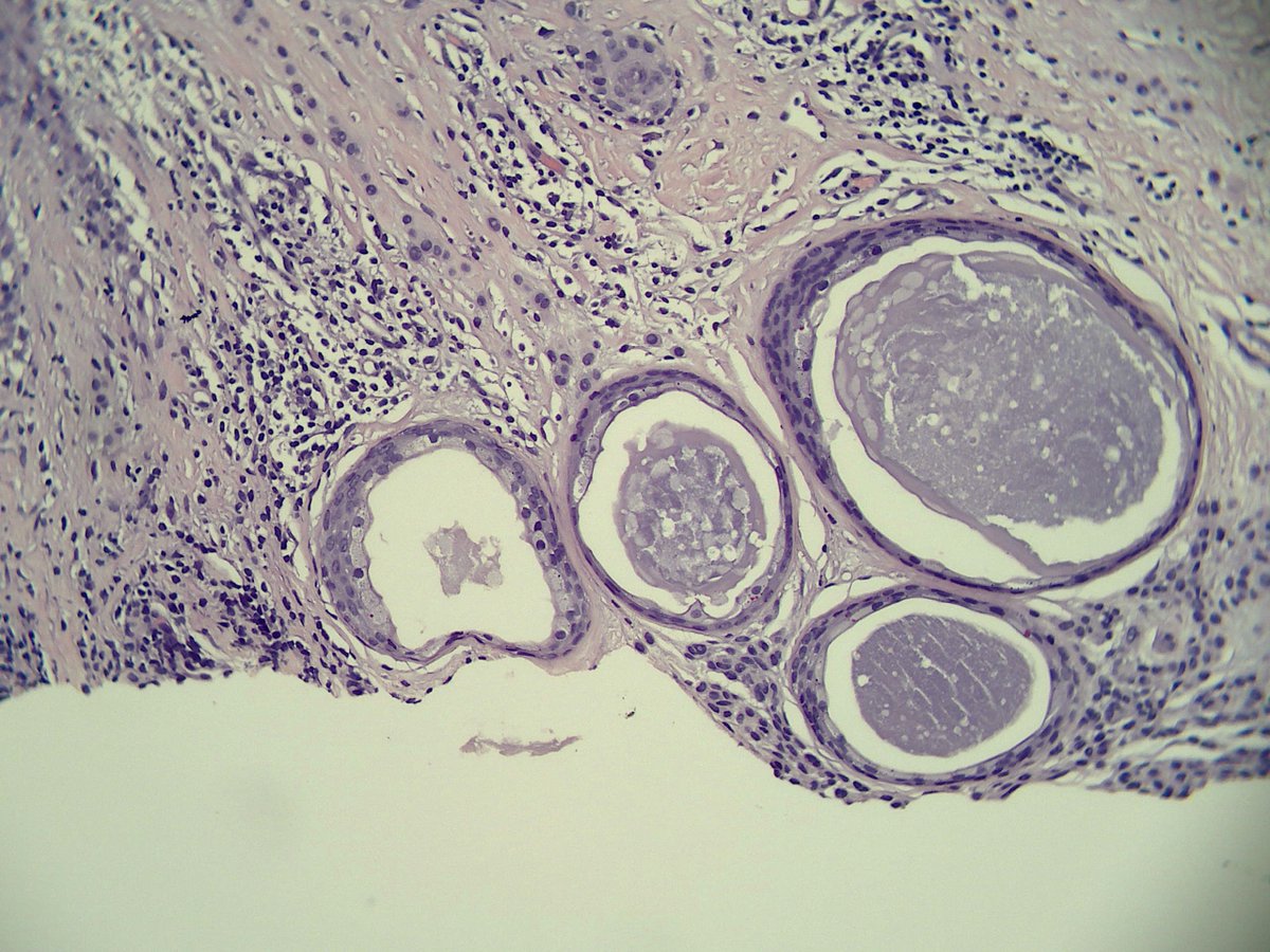 60s♀️trunk, R/O BCC.
Nevus, and something else. What would you call this...some kind of eccrine benignoma? syringoma? Thank you! 🙏
#dermpath <a href="/mccalmo/">Tim McCalmont</a> <a href="/HENRYY_MD/">Henry YANG</a> <a href="/AlomariDermpath/">Ahmed Alomari, MD</a> <a href="/DiegoMoralesN/">Diego Morales, MD</a> <a href="/PIorfino/">Dermpath_doc_trish</a> <a href="/ChristineJKoMD/">Christine J. Ko, MD</a> @ArjunRamaiya1 <a href="/et565/">Etan Marks, DO</a> <a href="/david_terrano/">David Terrano</a> <a href="/FrozenSections/">Anurag Sharma</a>
