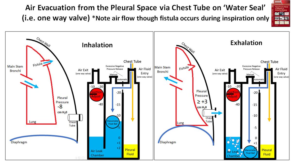 LandsbergManual's tweet photo. PTX Rx:
Suction ONLY for initial evacuation, or PROGRESSIVE lung deflation on H2O seal, NOT to ‘force pleural apposition for 24-48 hrs to seal the hole’
Tol a sig 'residual' PTX on H2O seal, to not suck
 #Meded #MedTwitter #pulmonary #criticalcare #IP #anesthesiology #hospitalist https://t.co/KlRL1Ka44j