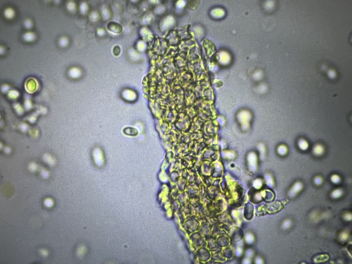 msc271's tweet photo. 56YO Nepalese woman with PMH of CKD, Bx-proven MPO+ AAV likely 2/2 infection, HTN, T2DM, stroke, CAD who presented as a transfer from OSH for hematology evaluation due to persistent severe pancytopenia. #UrinarySediment #UrineMicroscopy #RBCCast #Acanthocytes https://t.co/XYx4ambmbY