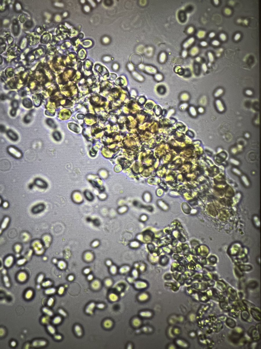msc271's tweet photo. 56YO Nepalese woman with PMH of CKD, Bx-proven MPO+ AAV likely 2/2 infection, HTN, T2DM, stroke, CAD who presented as a transfer from OSH for hematology evaluation due to persistent severe pancytopenia. #UrinarySediment #UrineMicroscopy #RBCCast #Acanthocytes https://t.co/XYx4ambmbY