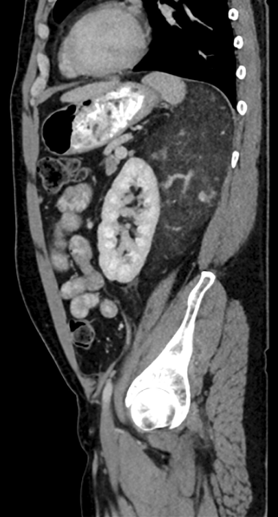 New #EarlyView article:

Beyond size criteria for predicting rupture in Renal angiomyolipomas: ow.ly/845t50PBfIU