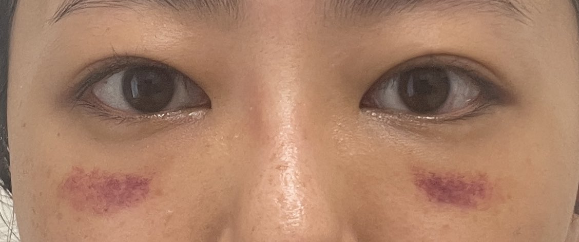 kgpki's tweet photo. 目の下のクマ取り　
経結膜脱脂 + 脂肪注入　DT9日目
もうだいぶ戻ってきた！
1ヶ月で90%くらいの完成度にはなるとのこと。
しばらく変化が見られなさそうなのでレポはこの辺にしようかな？ https://t.co/vgfidSVRA0