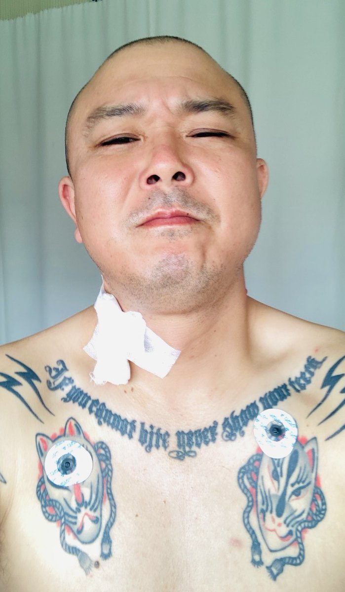 Junichiraw's tweet photo. 【お知らせ】皆様のお陰様で手術は無事に終わりました。術後は合併症に苦しみましたが現在は落ち着いています。ご心配おかけしました。画像1は絶対安静解除直後。画像2は点滴等の繋がれた管や線を全て引きちぎり、病室を脱走する直前。身体中全ての��胞が復讐を誓い活性化しているのがわかる。 https://t.co/OmqjpGrKxP