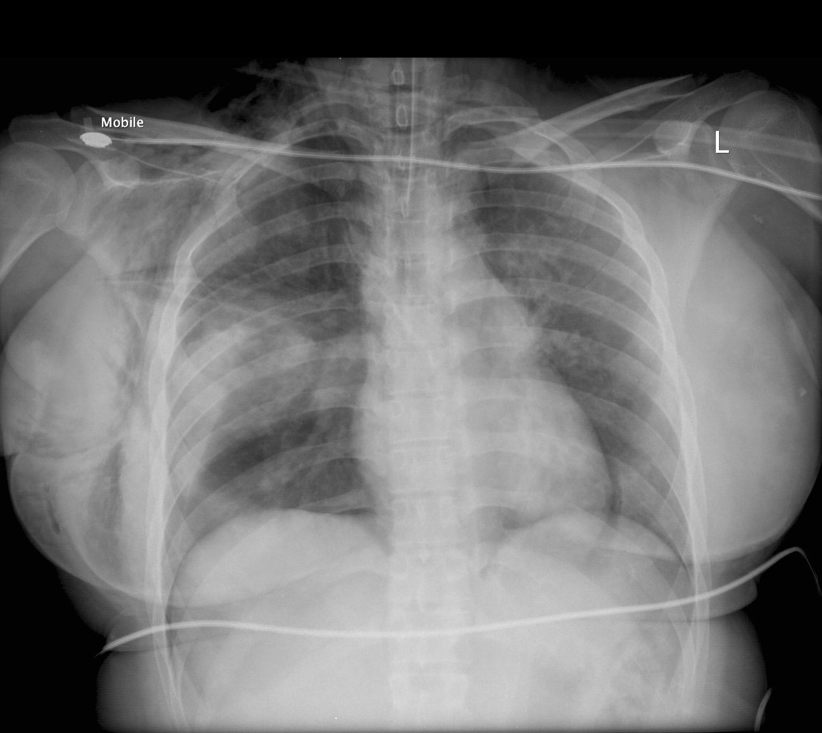 A 53 year old horserider falls and is rolled on by the horse.  She is intubated at the scene for respiratory failure and agitation.  

What does her initial CXR show?  osler.app.link/Pn4RiwAUqCb 

#medtwitter #traumatwitter #juniordoctors #juniordocs #medstudenttwitter #medstudents…