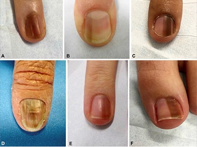AADmember's tweet photo. “Every dermatologist has examined a pigmented nail, wondering if the pathologic process reflects a nail unit melanoma or subungual melanoma versus a benign melanocytic lesion, pigmented onychomycosis, or hemorrhage.” #DermWorld Insights and Inquiries - https://t.co/7Zk4TlSey9 https://t.co/DTvr61b6hV