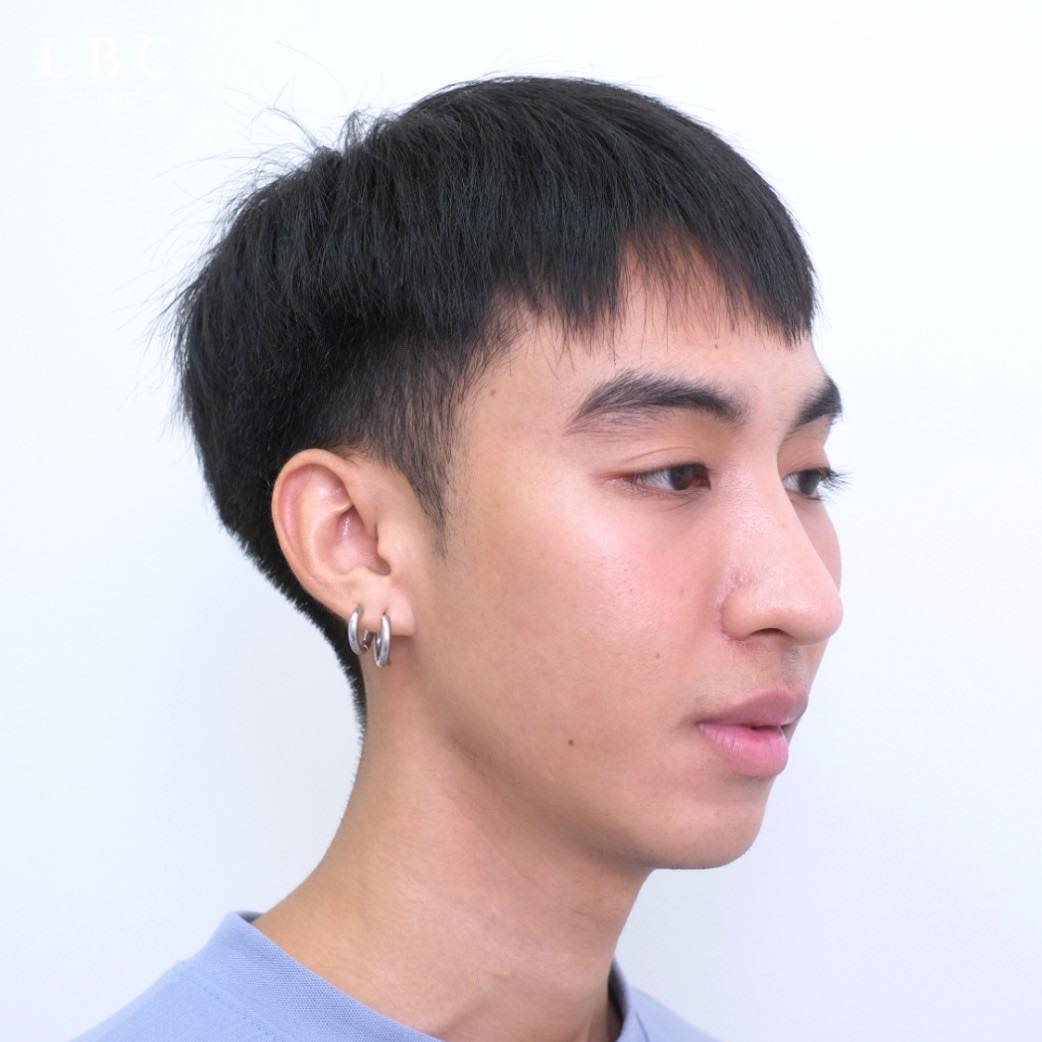LBCClinic's tweet photo. เติม Jawline สร้างกรอบหน้าคมชัด คืออะไรคะ !?
Jawline (สร้างกรอบหน้า) สร้างความคมชัดของกรอบหน้าให้ชัดขึ้น โดยใช้เทคนิคเฉพาะไม่ต้องทำการผ่าตัด แต่ได้ผลลัพธ์ของกรอบหน้าที่ชัดเจน ช่วยยกกระชับผิวหน้า ลดความหย่อนคล้อยและความกลมของใบหน้าลง เพิ่มความเรียว ใบหน้าดูมีสันคมดูดี��นทุกมิติ https://t.co/vaos6DVDx0