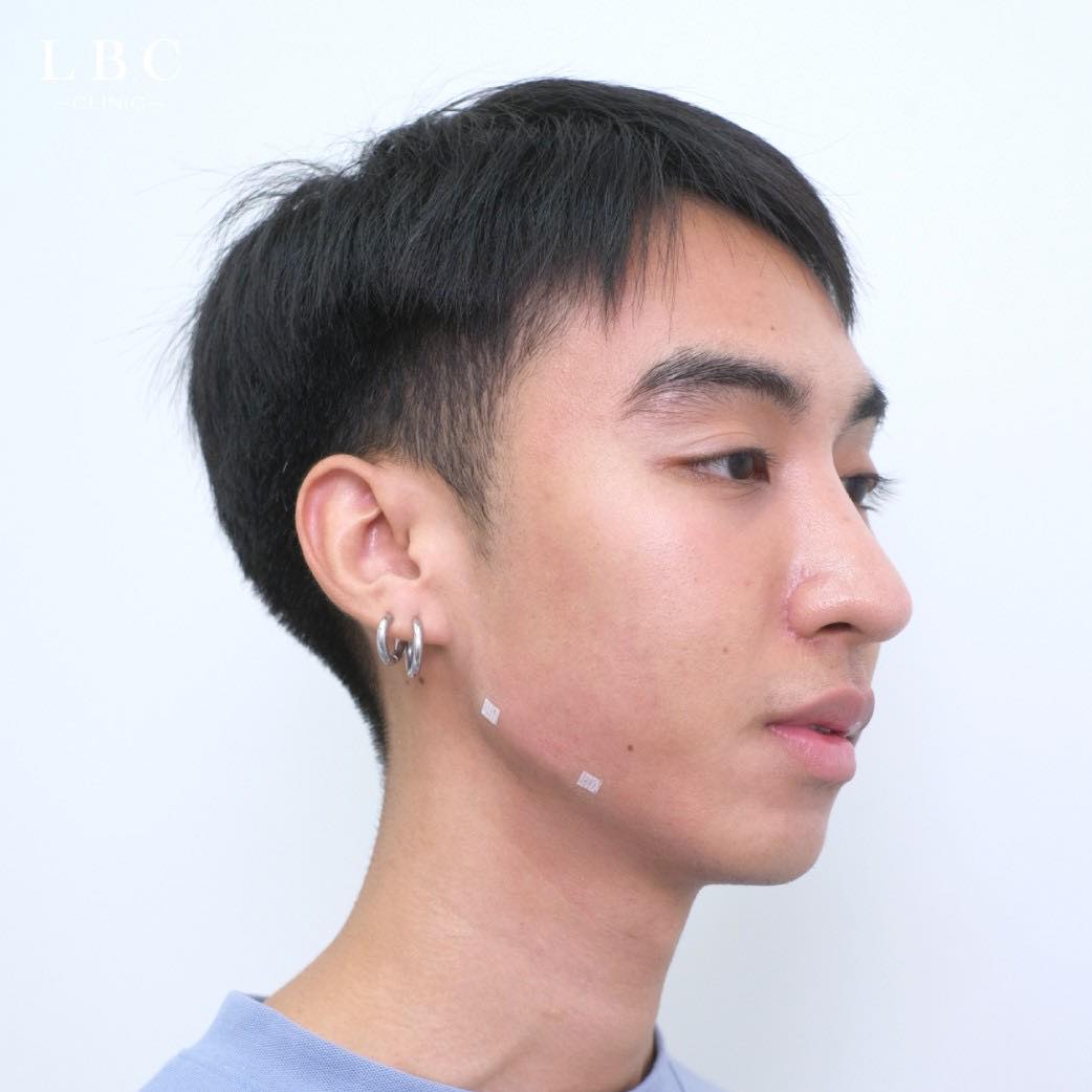 LBCClinic's tweet photo. เติม Jawline สร้างกรอบหน้าคมชัด คืออะไรคะ !?
Jawline (สร้างกรอบหน้า) สร้างความคมชัดของกรอบหน้าให้ชัดขึ้น โดยใช้เทคนิคเฉพาะไม่ต้องทำการผ่าตัด แต่ได้ผลลัพธ์ของกรอบหน้าที่ชัดเจน ช่วยยกกระชับผิวหน้า ลดความหย่อนคล้อยและความกลมของใบหน้าลง เพิ่มความเรียว ใบหน้าดูมีสันคมดูดี��นทุกมิติ https://t.co/vaos6DVDx0