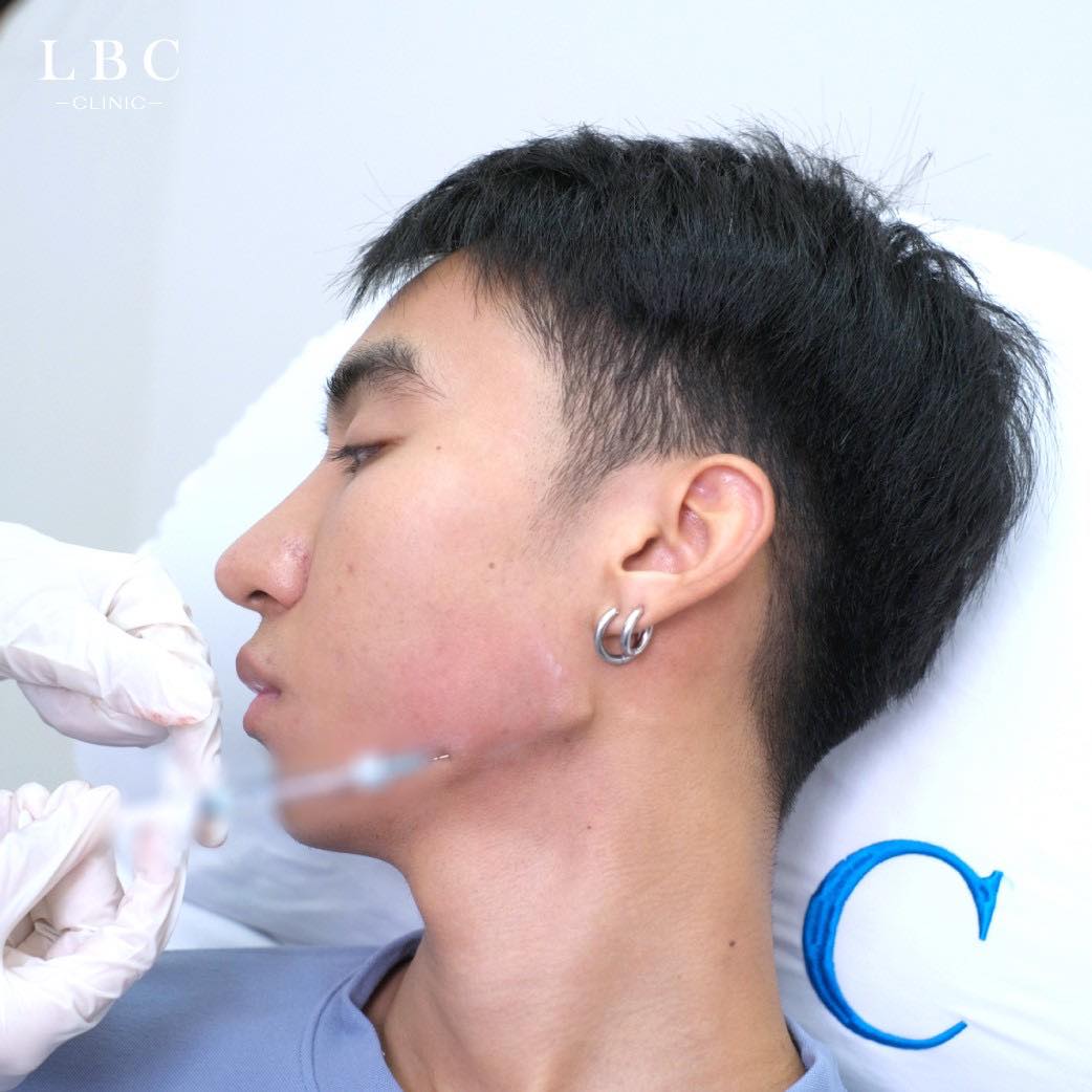 LBCClinic's tweet photo. เติม Jawline สร้างกรอบหน้าคมชัด คืออะไรคะ !?
Jawline (สร้างกรอบหน้า) สร้างความคมชัดของกรอบหน้าให้ชัดขึ้น โดยใช้เทคนิคเฉพาะไม่ต้องทำการผ่าตัด แต่ได้ผลลัพธ์ของกรอบหน้าที่ชัดเจน ช่วยยกกระชับผิวหน้า ลดความหย่อนคล้อยและความกลมของใบหน้าลง เพิ่มความเรียว ใบหน้าดูมีสันคมดูดี��นทุกมิติ https://t.co/vaos6DVDx0