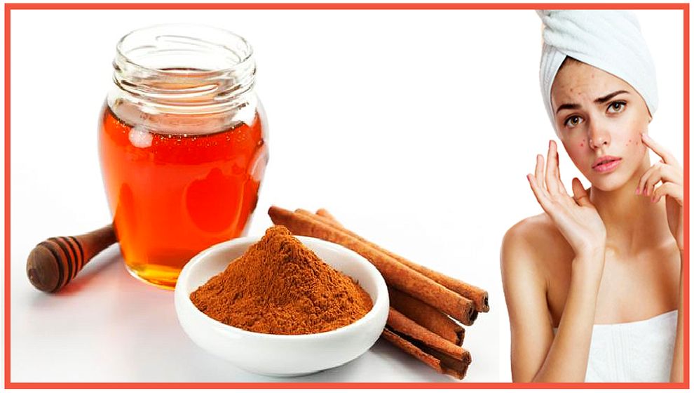 haberiskelesi's tweet image. Sivilcelerinizden bir haftada kurtulun! Cilt kusurlarına veda ettiren formül...
#Saglik #sivilceler #honeymask #mask #skincare #Health #beauty 

magaziniskelesi.com/haber/sivilcel…