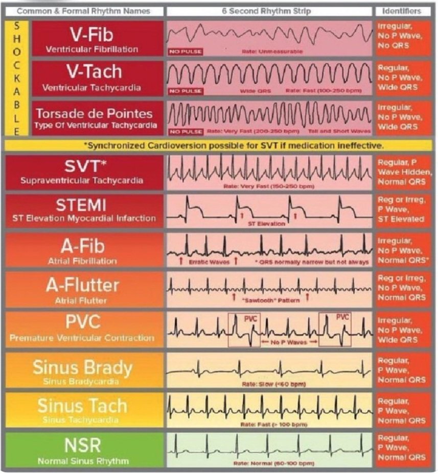 walinjom's tweet photo. Common importent ECG rythmes: https://t.co/emu0IsfM15