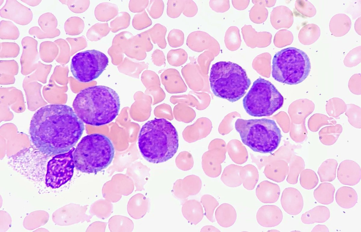 jimmunoallerg's tweet photo. T-cell acute lymphoblastic leukemia (T-ALL) is a type of acute leukemia meaning that it is aggressive and progresses quickly. It affects the lymphoid-cell-producing stem cells, in particular a type of white blood cell.
#leukemia #lymphocytes #Tcells #immunology #lymphoblastic https://t.co/7c0l5G1hOM