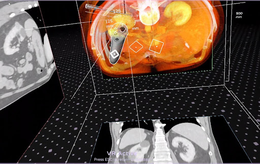 #CaseReport “Renal Cryoablation Preparation Using Virtual Reality' presents an effective method using AVATAR MEDICAL to plan and perform virtual cryoablation procedures for treating renal cell carcinoma (RCC) tumors with minimal damage to nearby organs. lnkd.in/dFPEDFPF