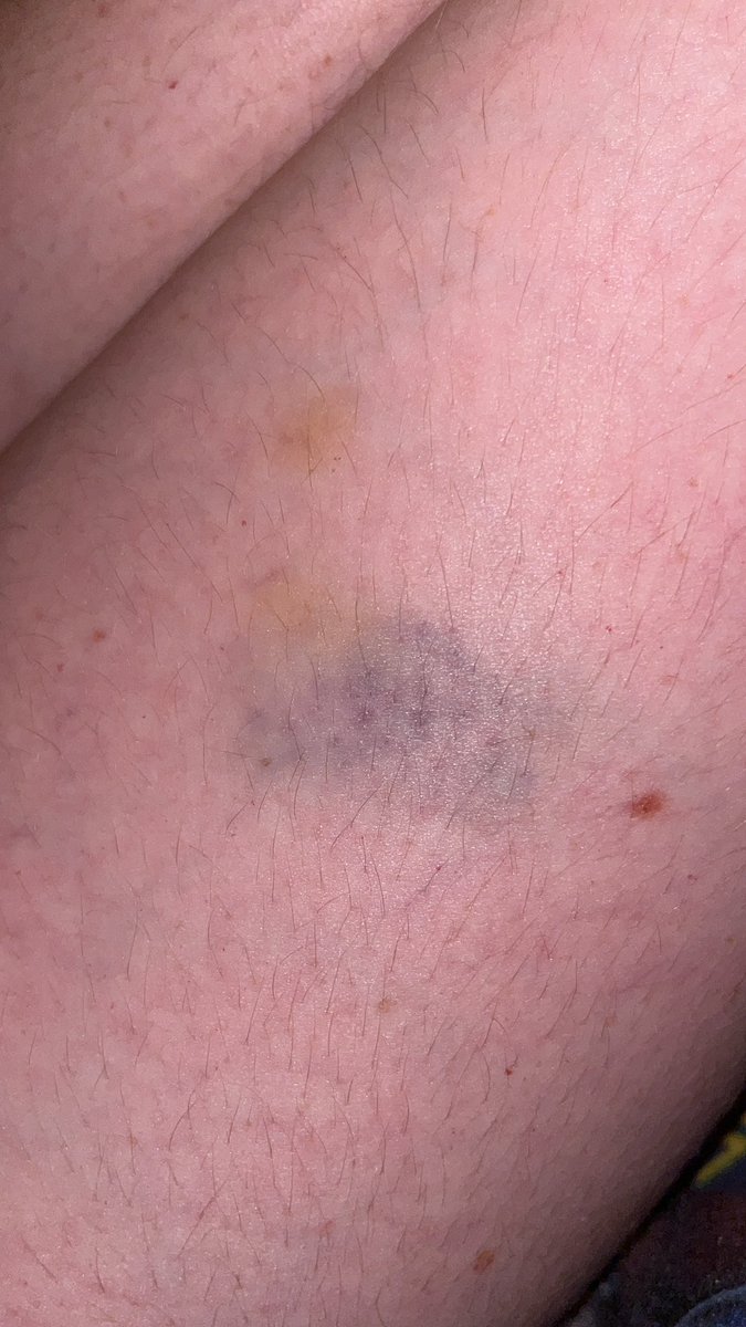 LEAVESOFDANCE's tweet photo. яდυgє .

I get more bruises at Disneyland then anywhere else (unless I’m working) https://t.co/YJZFVkHVPK