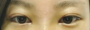 futaediary's tweet photo. Kumiさん(28)の埋没正直レポ👀

🏥クリニック：品川美容外科クリニック
👨‍⚕️執刀医：和田先生
✏️メニュー名：二重埋没、笑気麻酔
💰料金：22,810円

ダウンタイム★★★★★
施術当日↓
....
ダウンタイム2日目↓
....1週間ほどで化粧はできましたが、完全に腫れが引くのは1ヶ月くらいかかりました。痛みは我慢できるくらいのレベルではありましたが、術後当日と次の日はやはり痛かったですね。

カウンセリング★★★★★
どんな二重幅にしたいか等、具体的なところまで丁寧に話し合い、金額と理想に合った施術ができたので良かったです。
before↓
....

執刀医の技術★★★★★
態度・対応★★★★★
丁寧で常に痛くないかなど気を遣っていただいたのでとてもスムーズに施術が進みました。他のスタッフさんもとても優しかったです。
after↓
....
みんなにアドバイス！:
悩みがあっという間に解消できるのでおすすめします！

さらに詳しいレポはプロフリンクから✨
クリニックや執刀医ごとにレポを探せます📝
悪い口コミ、瞬きをしている動画も公開しています◎