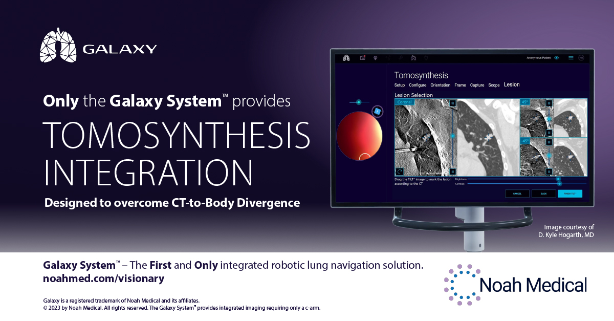 NoahMedical's tweet image. The Galaxy System™ with TiLT+ Technology is the FIRST and ONLY integrated lung navigation solution to provide Integrated Tomosynthesis. To find out more visit hubs.ly/Q01_CVsG0 #FirstAndOnly #NoahMedical #GalaxySystem #MedTech #LungCancer #Bronchoscopy