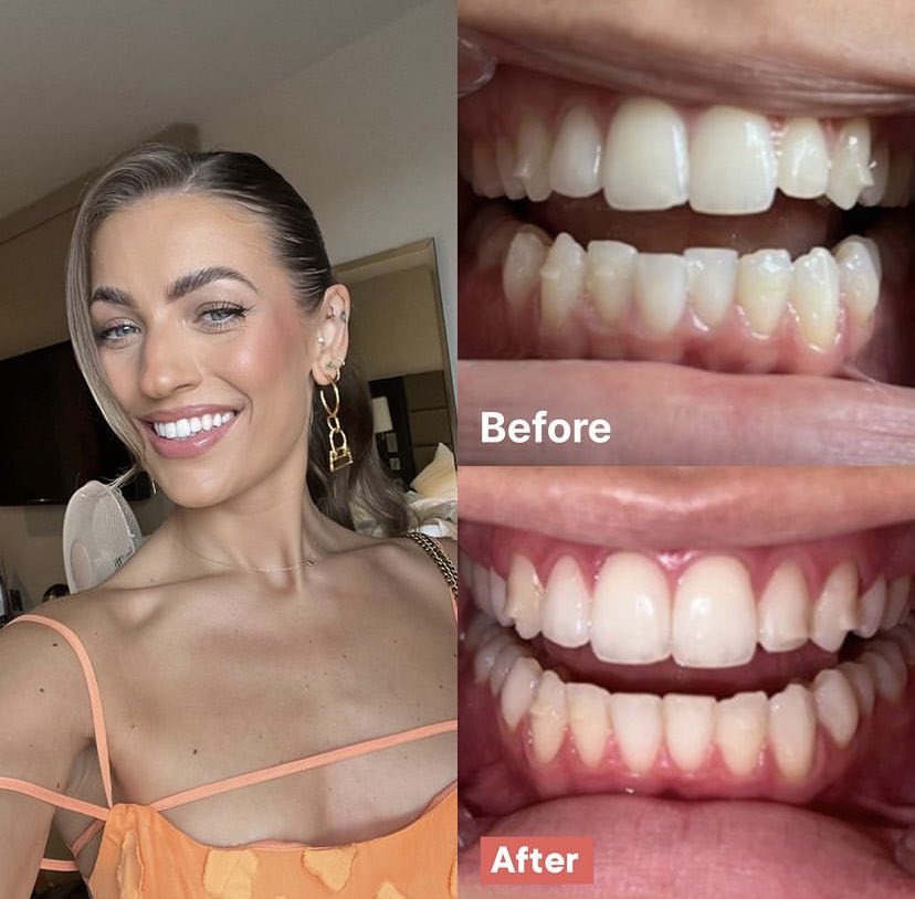 Maddie is smiling because she’s just completed her journey with DW aligners and her results look AMAZING!😍

Start your journey today from £99.99🦷

dwaligners.co.uk?