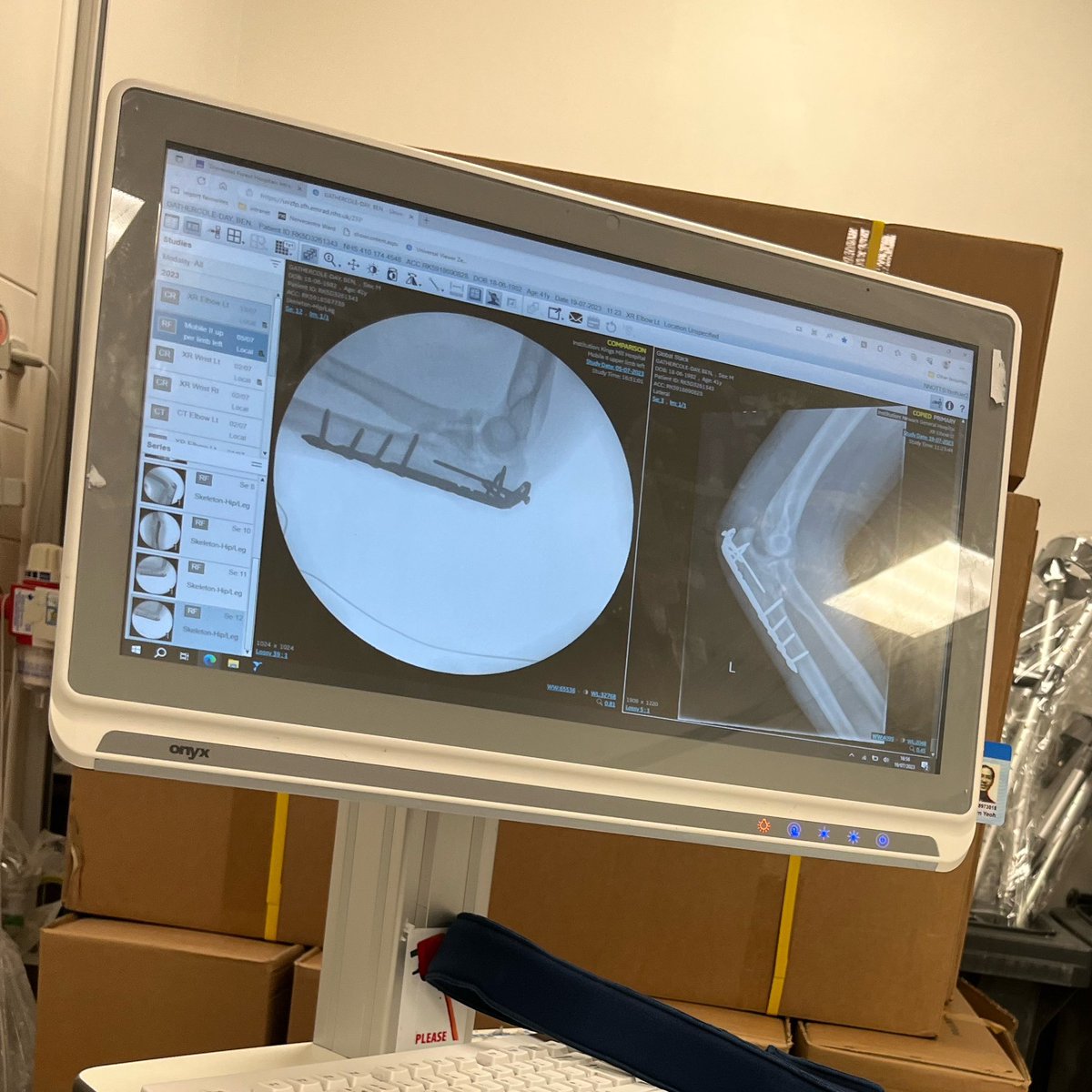 BenGathercole's tweet photo. Today is the day I have my cast off. I’m excited to have it off but nervous to see if the 2nd op actually worked. Initial X-rays seemed ok but only taking the cast off will tell it the elbow will dislocate. I will never take my arms or my free time for granted again! Onwards. https://t.co/isVBIfsyQt