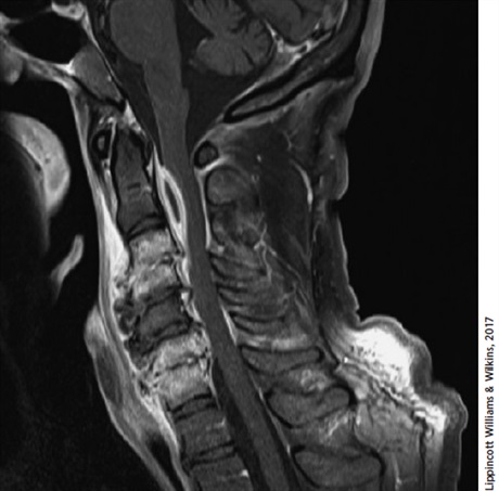 EMNews's tweet photo. #Spinalepiduralabscess is often missed, esp bc the classic symptoms occur in less than 15% of pts. Charles Pilcher MD says making the correct dx is easy: Think of SEA when a pt has back/neck pain—&amp; save yourself from a #malpractice suit at the same time. https://t.co/LBzfSxNZOa https://t.co/dGgqlCJb6R